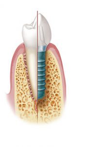 Implantologie in der Potsdam Oralchirurgie