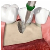 Der Knochenaufbau - Potsdam Oralchirurgie