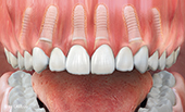 Keramikimplantate Berückenversorgung auf festsitzender Zahnreihe