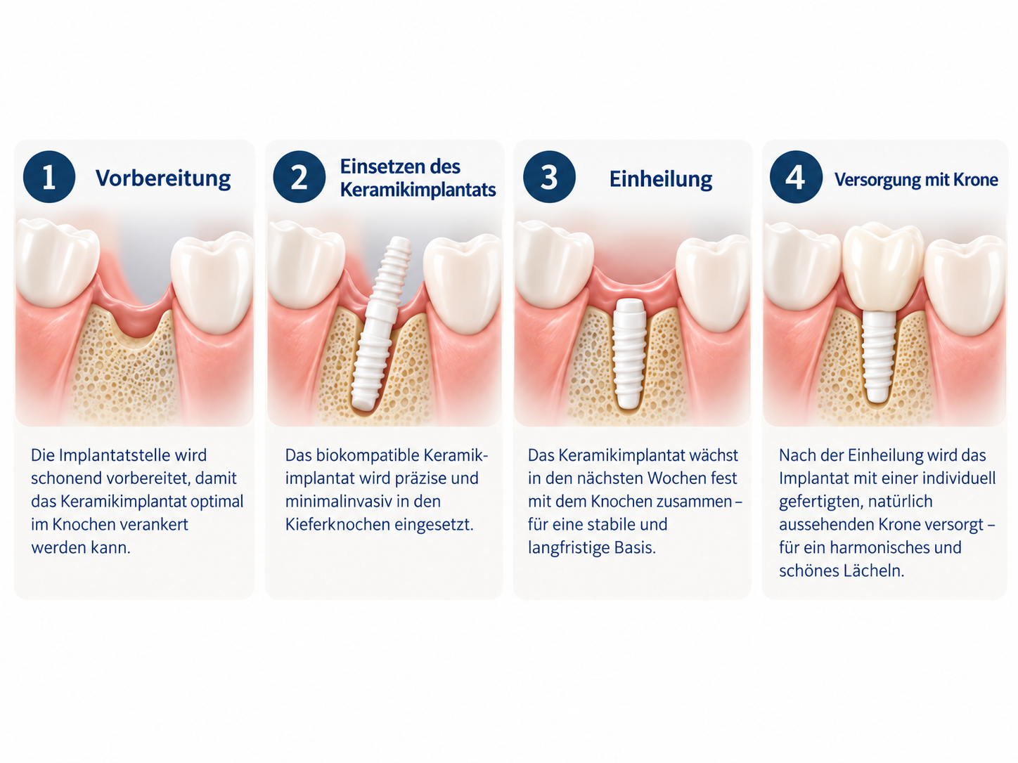 Vier Schritte zum Keramikimplantat – Vorbereitung, Einsetzen, Einheilung und Versorgung mit Krone